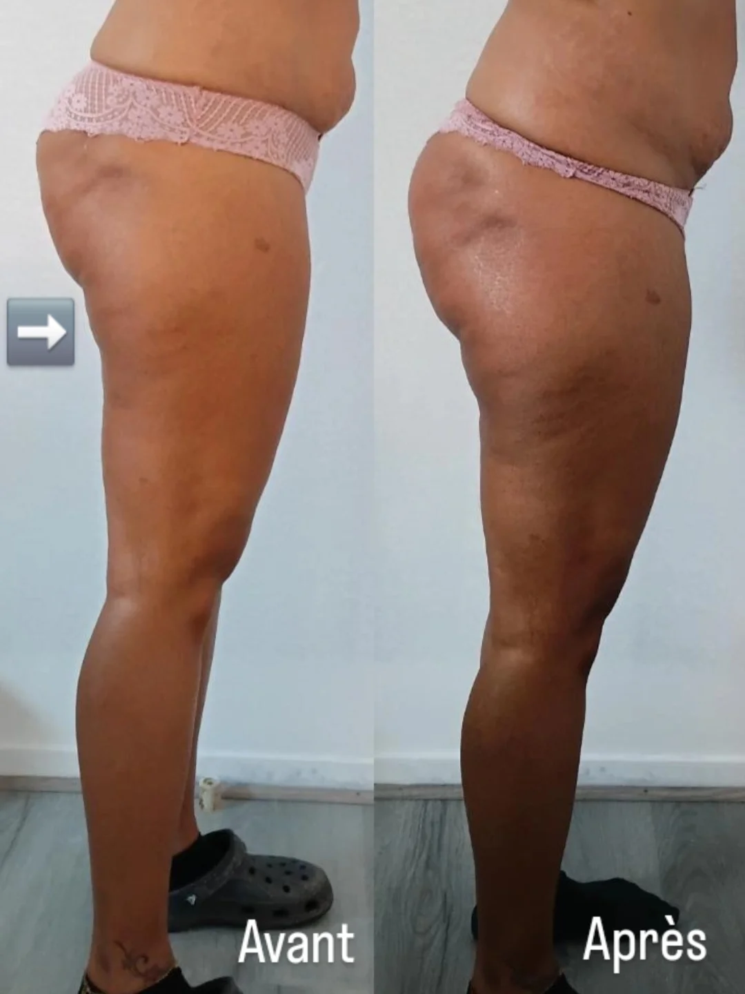 Avant - Lipocavitation
